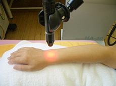 レーザー光線治療