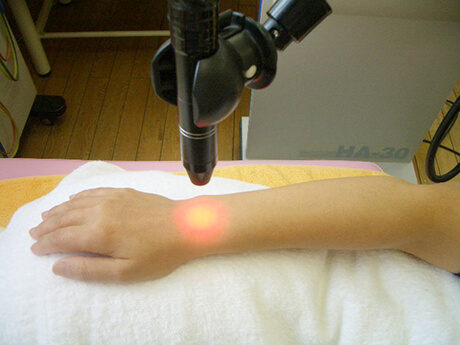 レーザー光線治療