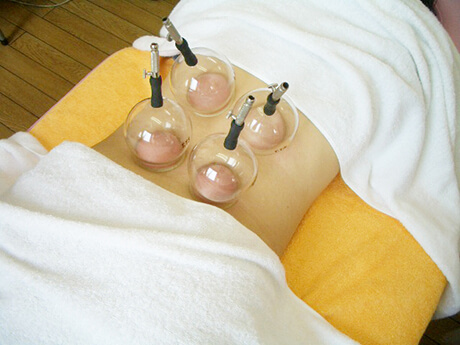 カップ(吸玉)吸引療法